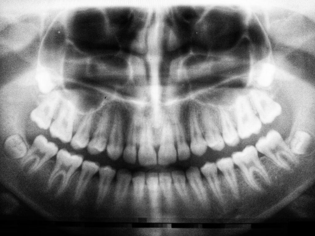 a dental x-ray of a complete set of teeth